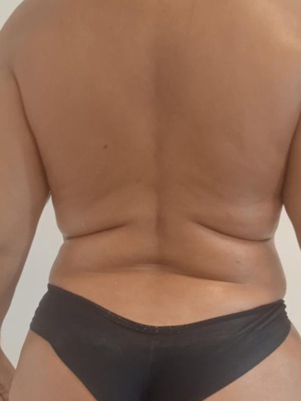 gorduradepois