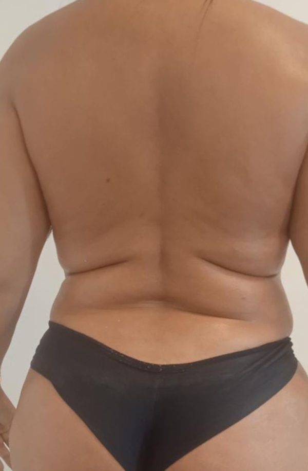 gorduradepois